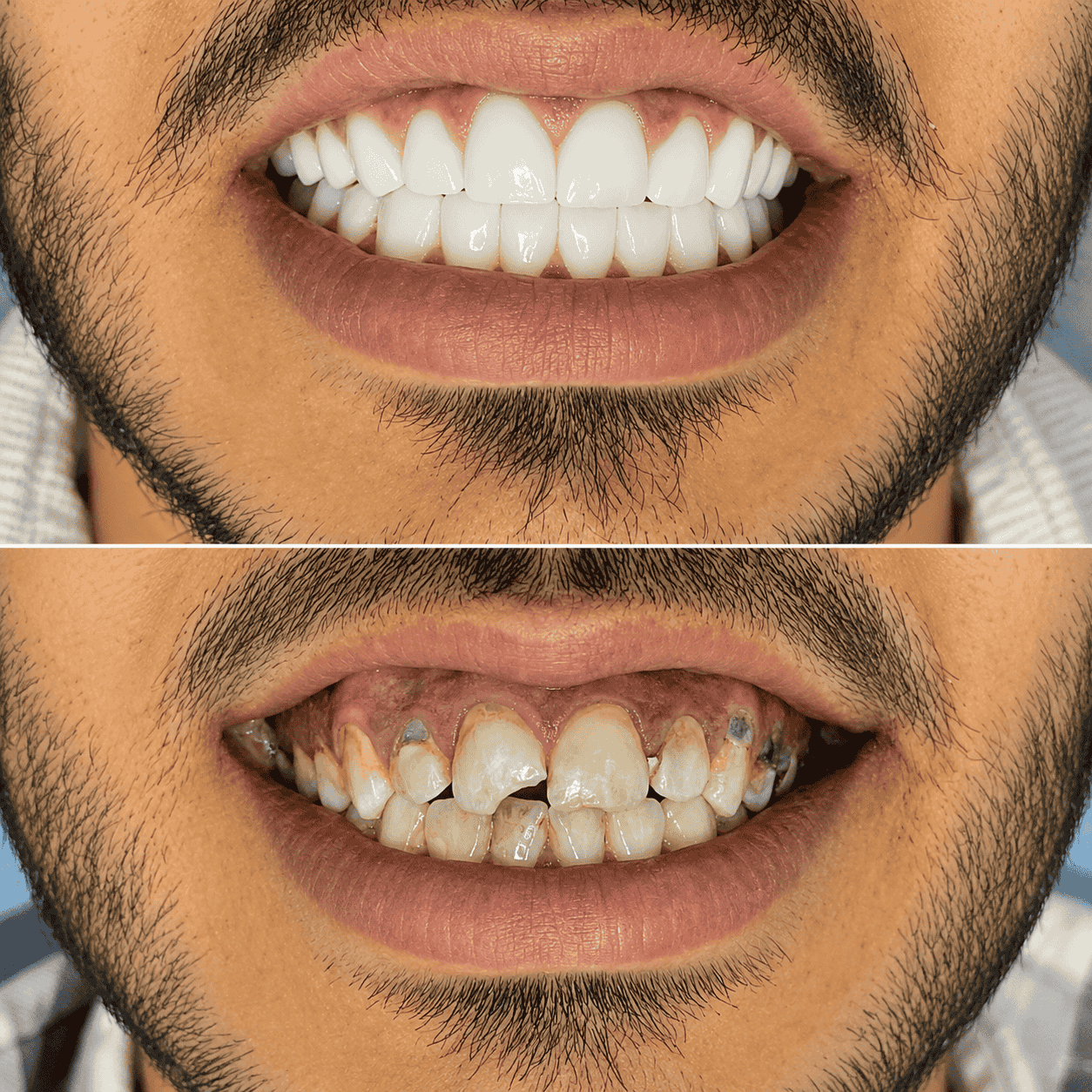 حالة أسنان تمت معالجتها - الحالة 1